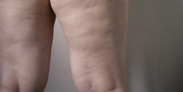 Lipedema Lipedema